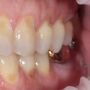 Абфракція Зубів: Причини, Ознаки та Лікування - Повний Путівник для Вашої посмішки