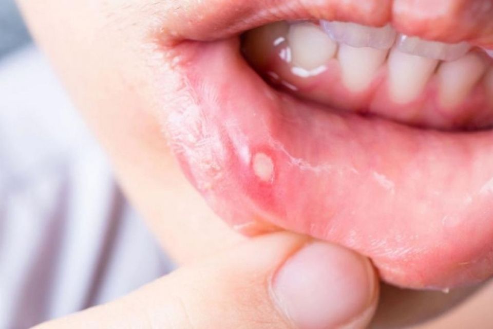 Стоматит наприкінці зими: чому виразки в роті загострюються перед весною? (новини компаній)