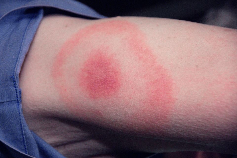 Мешканка Хмельниччини захворіла на хворобу Лайма через пів року після укусу кліща