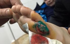 Інцидент у хмельницькому аквапарку: за порізану ногу обіцяють сімейний абонемент
