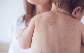 На кір у Хмельницькому захворіло майже 500 дітей