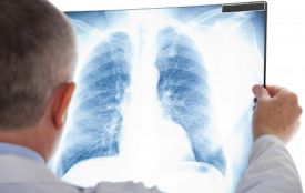 На Хмельниччині зростає захворюваність на туберкульоз: за 9 місяців – 315 випадків