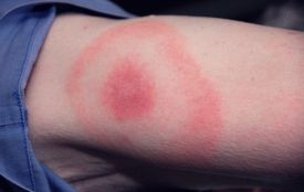 Мешканка Хмельниччини захворіла на хворобу Лайма через пів року після укусу кліща