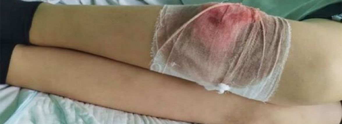 На Хмельниччині безпритульний собака вкусив дитину. Хлопчик в лікарні