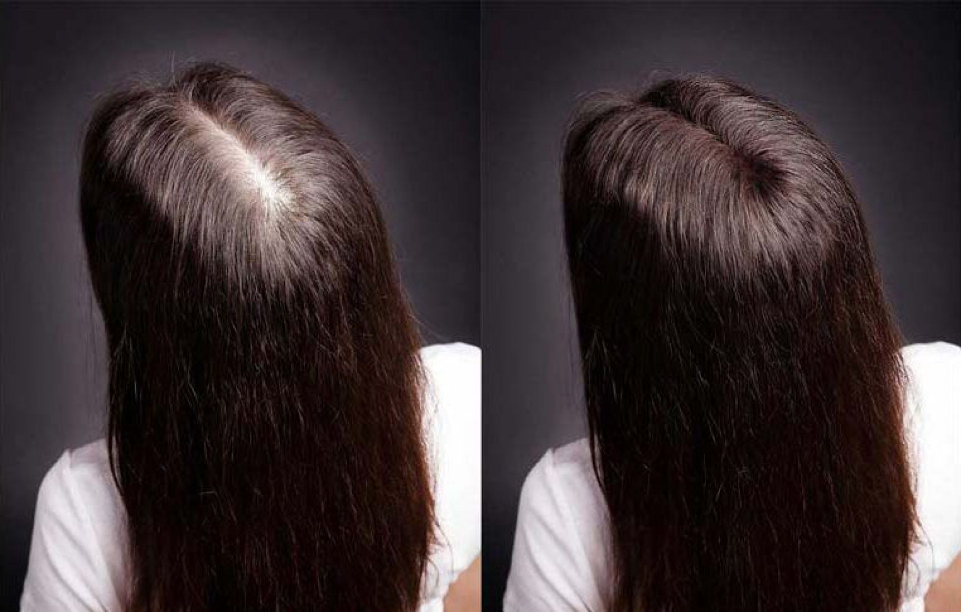 Мезотерапия волос до и после