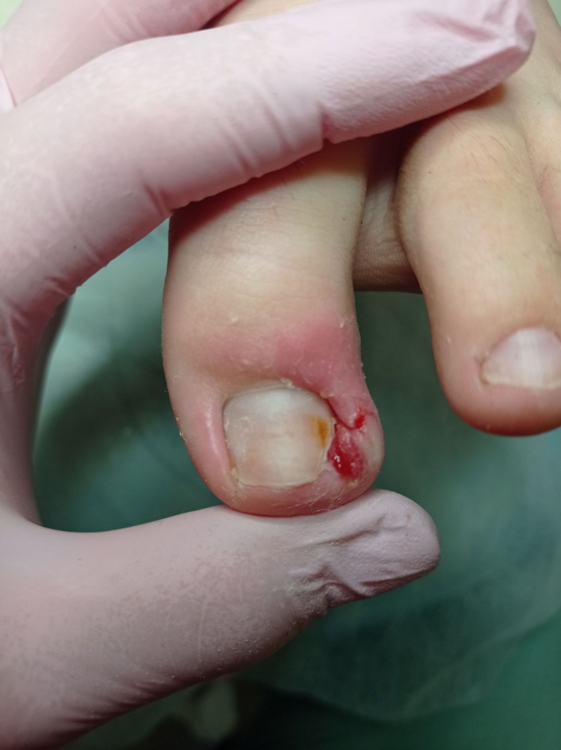 Після видалення кутика нігтя і санації рани